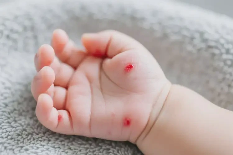 宝宝手上出湿疹不管它会自己自愈吗(图3)