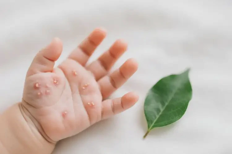 小兒全身容易起濕疹能靠自己自愈嗎(圖4)
