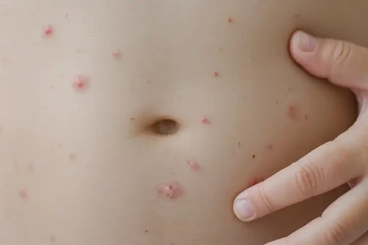 小兒肚子偶爾起濕疹不管它會自己痊愈嗎(圖4)