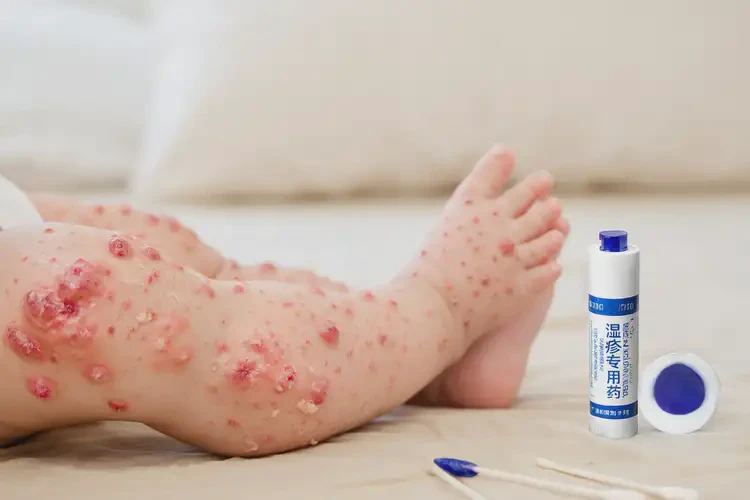 嬰兒小腿上起濕疹能靠自己自愈嗎(圖3)
