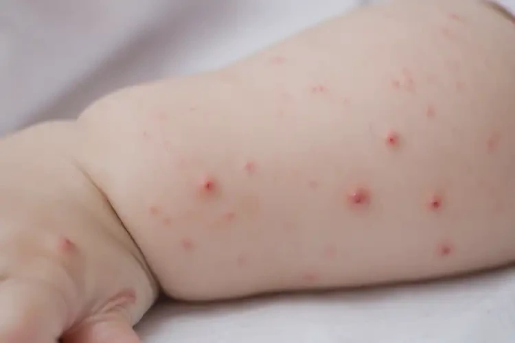寶寶手臂上容易起濕疹不管它會(huì)自己痊愈嗎(圖3)