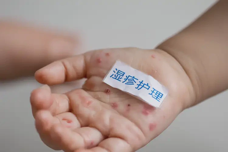 小學(xué)生手上有濕疹能靠自己自愈嗎(圖4)