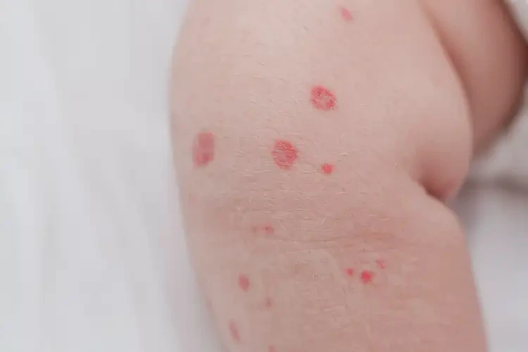 新生兒大腿上起濕疹不管它會自己好嗎(圖4)