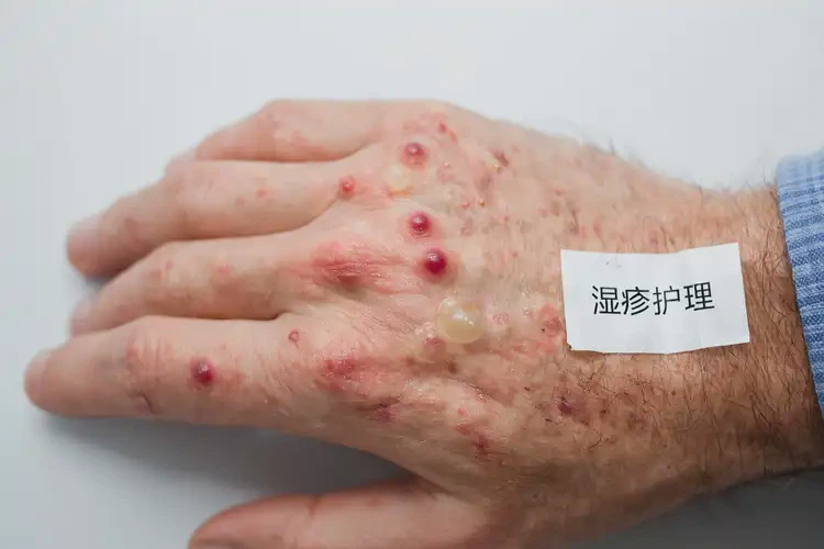 男生手上出濕疹能徹底自愈嗎(圖4)