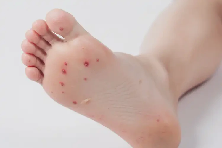 少兒腳上出現(xiàn)濕疹不管它會(huì)自己好嗎(圖2)