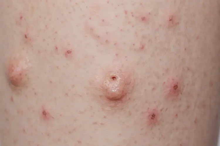 中學(xué)生小腿上經(jīng)常長濕疹能夠徹底治愈嗎(圖4)