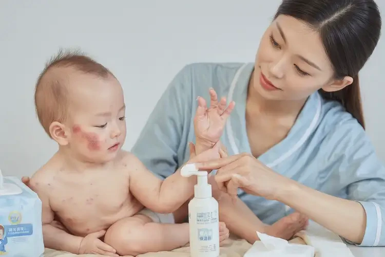 嬰兒手上有濕疹能靠自己自愈嗎(圖3)