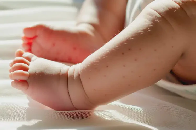 嬰兒小腿上偶爾起濕疹不管它會自己自愈嗎(圖3)