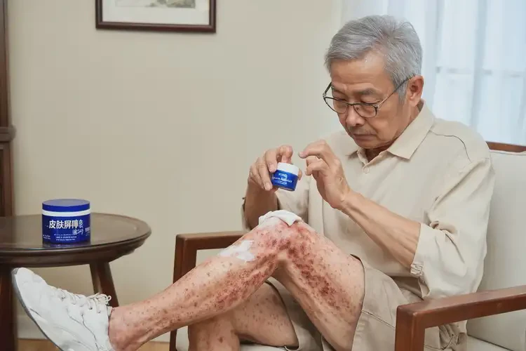 老年人大腿起濕疹可不可以徹底自愈(圖3)