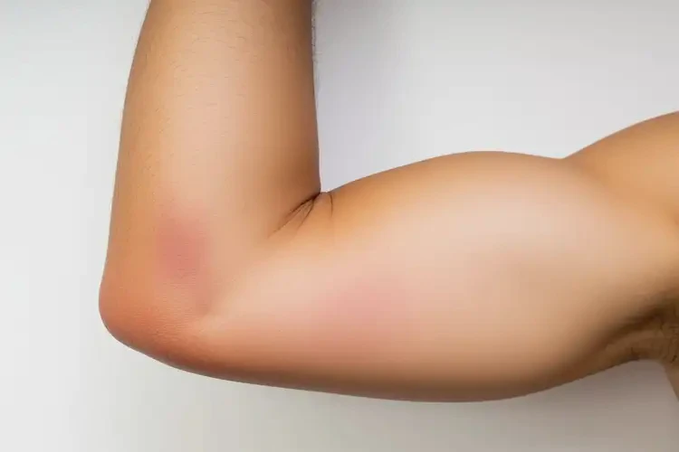 男生手臂上有濕疹能靠自己自愈嗎(圖1)