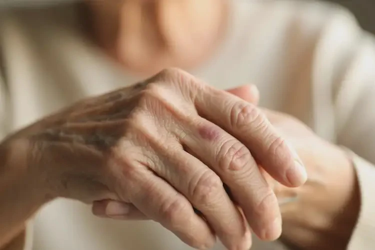 老年人身上偶爾起濕疹能夠徹底治愈嗎(圖4)