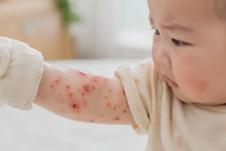 寶寶手臂上容易長濕疹不管它會自己痊愈嗎(圖4)