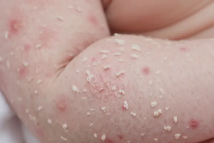 新生兒手臂上經(jīng)常起濕疹可以徹底自愈嗎(圖4)