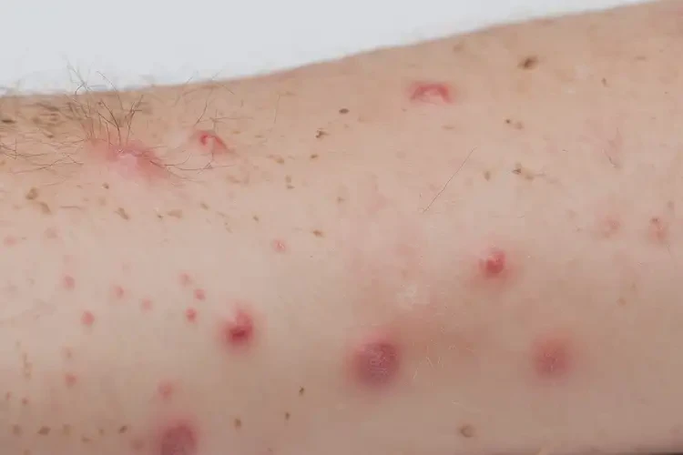 中學(xué)生手臂上長濕疹不管它會(huì)自己自愈嗎(圖4)