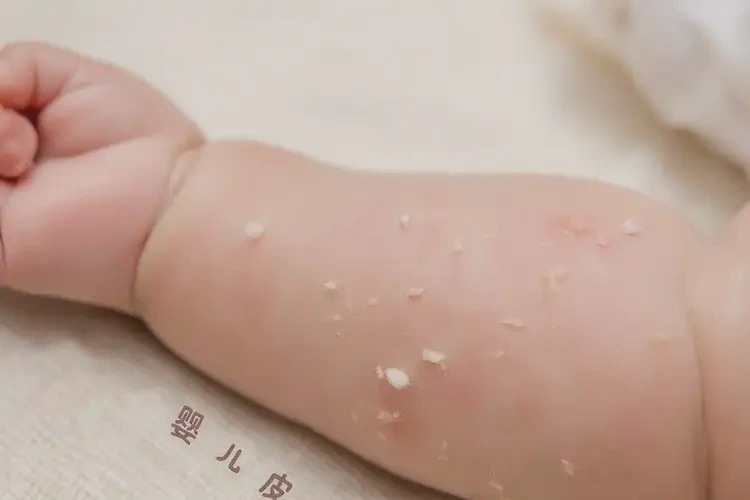 嬰兒手臂長(zhǎng)濕疹可不可以徹底自愈(圖1)