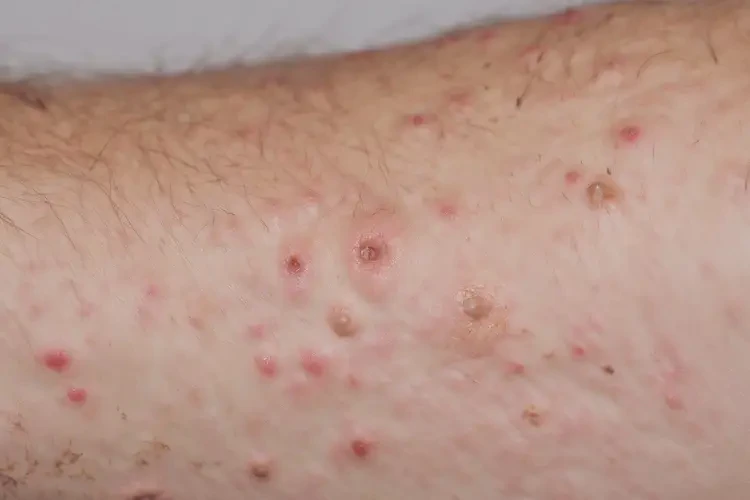 男生手臂出現(xiàn)濕疹可以徹底自愈嗎(圖4)