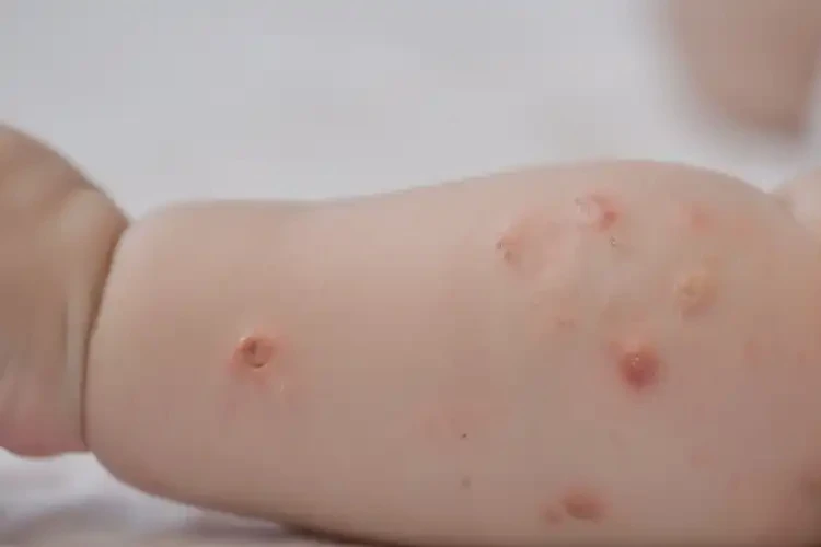 嬰幼兒手臂有濕疹可不可以徹底自愈(圖4)