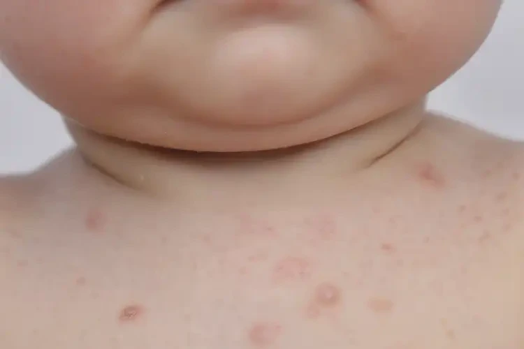 幼儿脖子上偶尔长湿疹可以彻底自愈吗(图4)