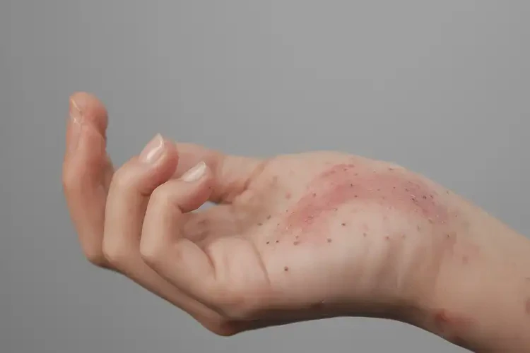 小學(xué)生手上長濕疹不管它會(huì)自己痊愈嗎(圖3)