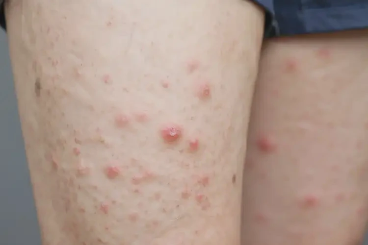 大學(xué)生小腿上偶爾起濕疹不管它會(huì)自己好嗎(圖4)