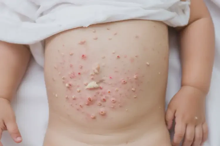 少兒肚子上容易長濕疹不管它會自己自愈嗎(圖4)