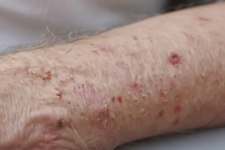 老年人四肢經(jīng)常起濕疹能靠自己自愈嗎(圖4)