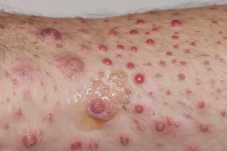 青年人屁股偶爾起濕疹不管它會(huì)自己自愈嗎(圖3)