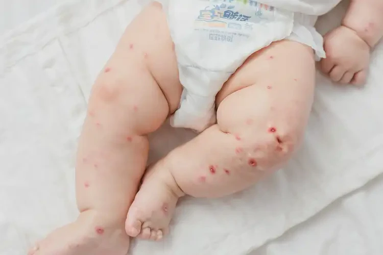 嬰兒大腿上起濕疹可以徹底自愈嗎(圖1)