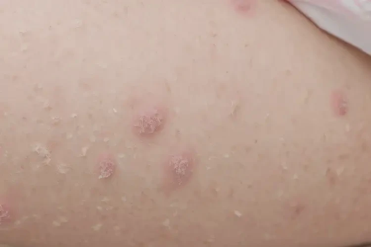 小儿大腿出现湿疹可不可以彻底自愈(图4)