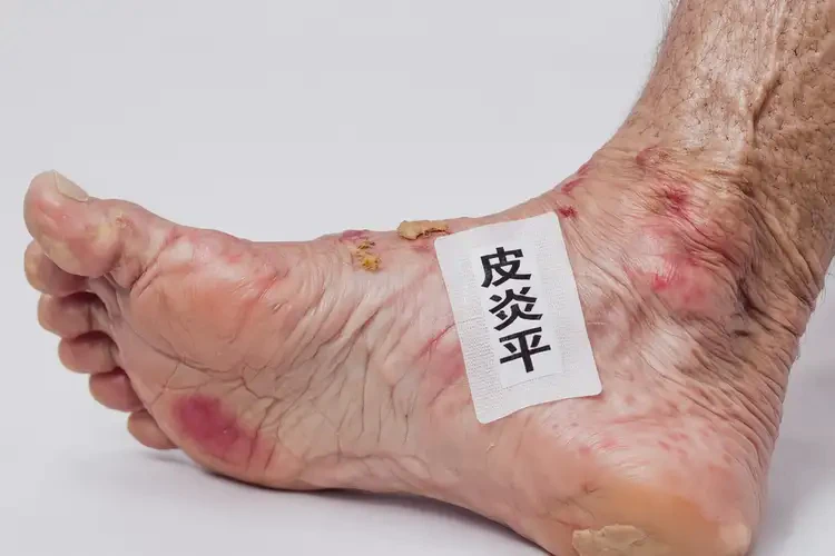 老年人腳上長濕疹不管它會自己自愈嗎(圖4)