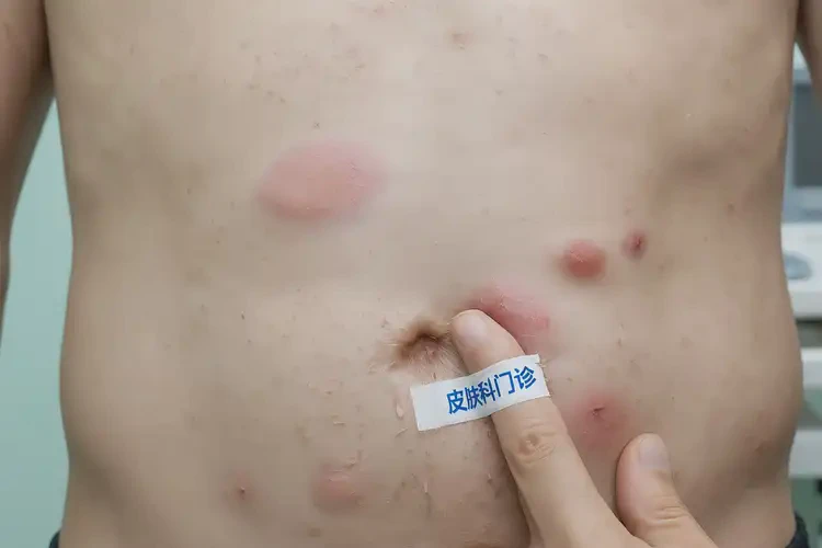 青年人肚子上長濕疹能夠徹底治愈嗎(圖4)