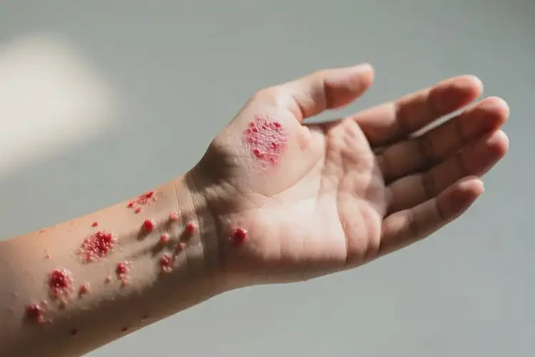 青少年手臂上出湿疹不管它会自己自愈吗(图3)