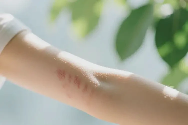 青少年手臂容易起濕疹能不能徹底自愈(圖4)