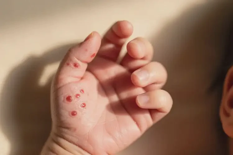 新生兒手上偶爾起濕疹不管它會自己好嗎(圖3)