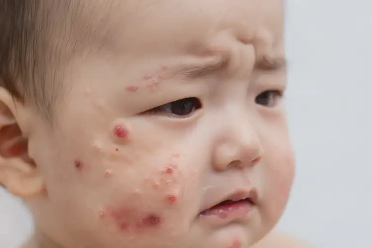嬰兒臉上起濕疹不管它會(huì)自己好嗎(圖3)