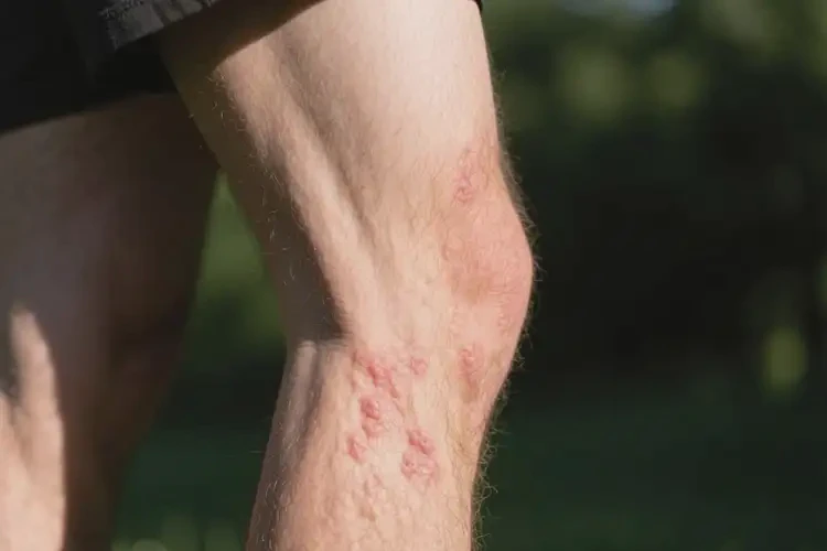 男生大腿容易起濕疹可以徹底自愈嗎(圖3)