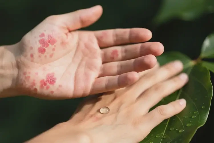 男性身上容易起濕疹能靠自己自愈嗎(圖3)