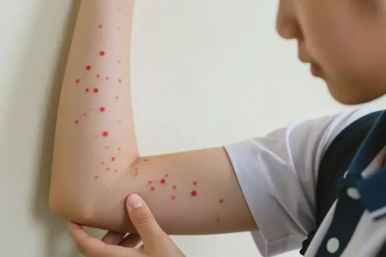 中學(xué)生手臂上起濕疹不管它會(huì)自己自愈嗎(圖3)