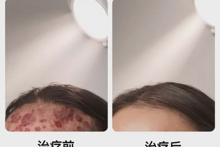 大學(xué)生屁股出濕疹能徹底自愈嗎(圖2)