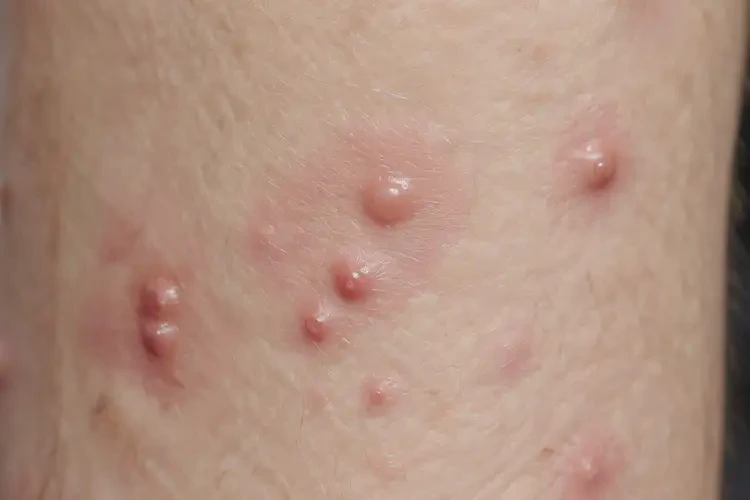 男生脖子長濕疹可不可以徹底自愈(圖4)