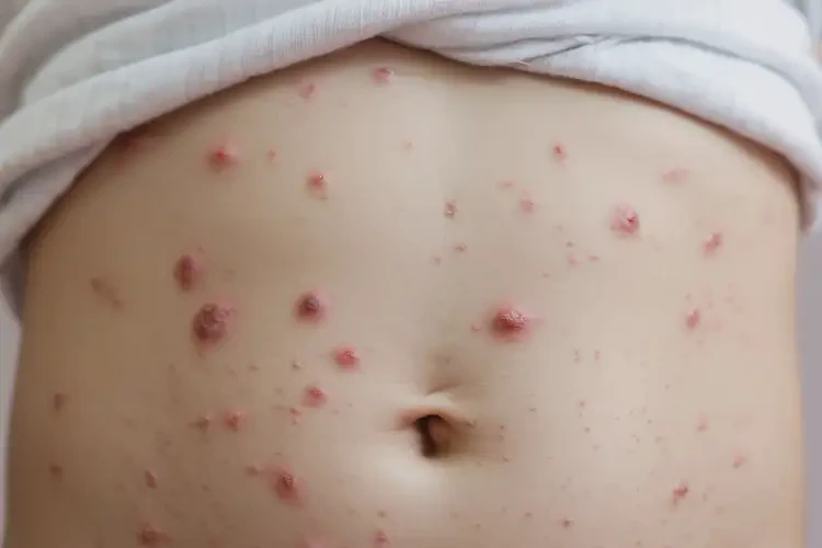 少儿肚子经常起湿疹不管它会自己自愈吗(图4)