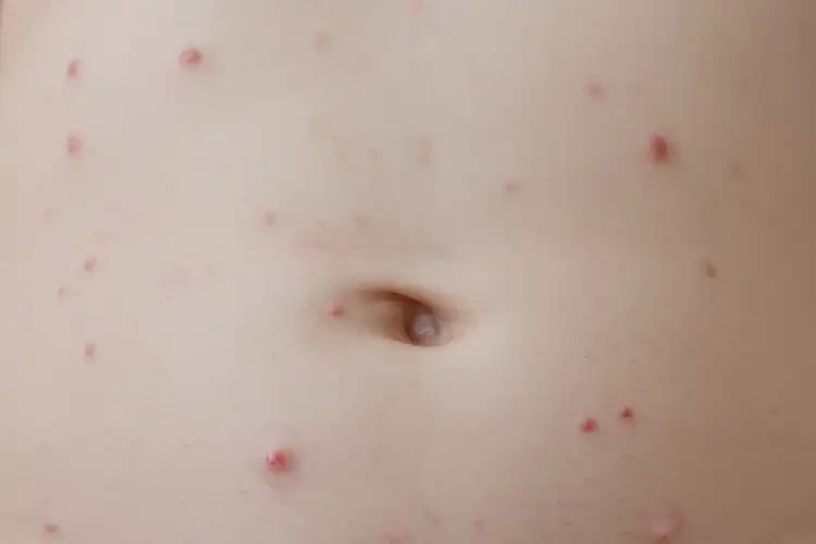 小孩肚子上出濕疹可以徹底自愈嗎(圖4)