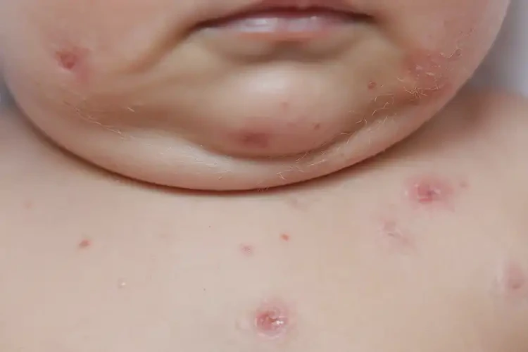 嬰幼兒脖子經(jīng)常起濕疹不管它會(huì)自己好嗎(圖4)