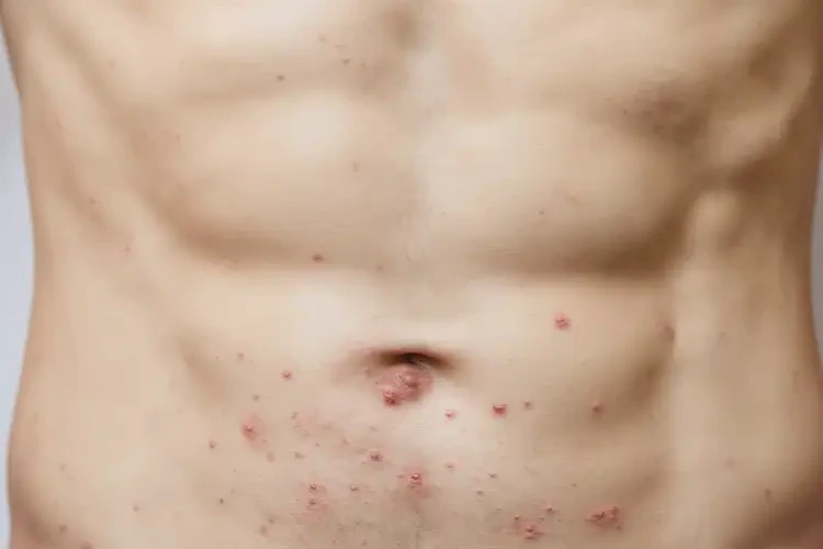 男生肚子上偶尔长湿疹可不可以彻底自愈(图4)