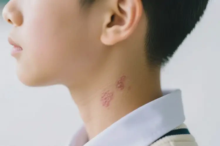 中學生脖子出濕疹不管它會自己痊愈嗎(圖2)