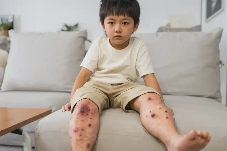 小学生四肢经常起湿疹不管它会自己好吗(图3)