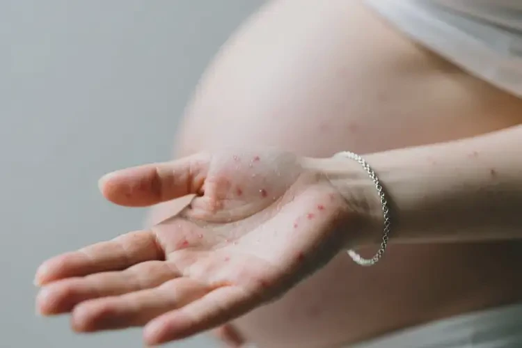 產(chǎn)婦手上長(zhǎng)濕疹不管它會(huì)自己痊愈嗎(圖2)