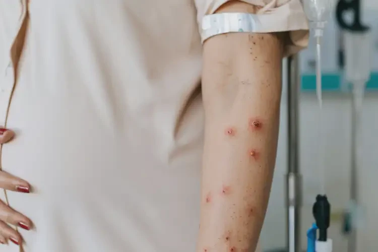 孕婦手臂偶爾長(zhǎng)濕疹能夠徹底治愈嗎(圖3)