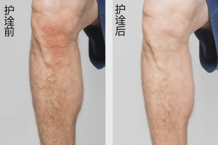 老年人大腿上有湿疹能不能彻底自愈(图2)