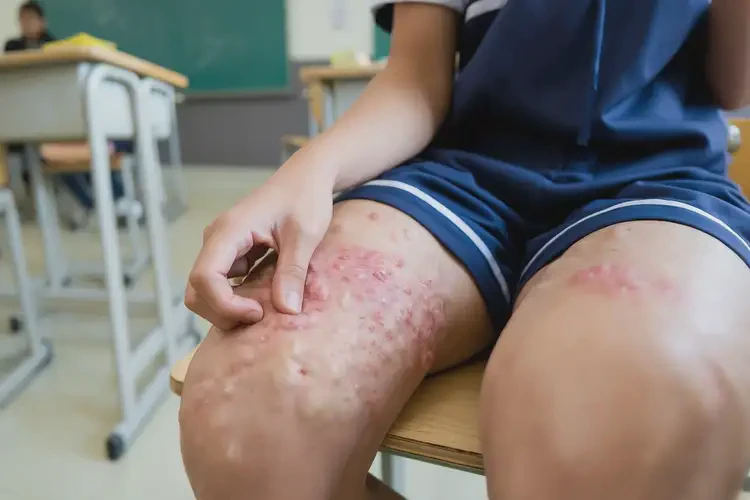 中學生大腿上起濕疹可以徹底自愈嗎(圖4)